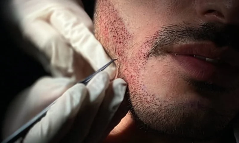 beard transplant beard transplant
